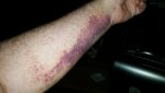 Brokenwrist1.jpg Brokenwrist1.jpg